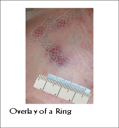 Overlay of a Ring
