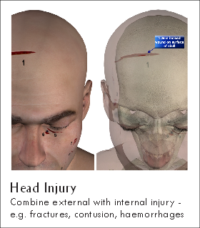 Head Injury
Combine external with internal injury -
e.g. fractures, contusion, haemorrhages